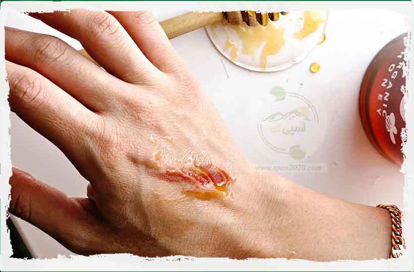 عسل درمان سوختگی